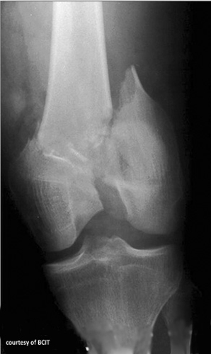 <p>What complications are linked with femoral condyle fractures?</p>