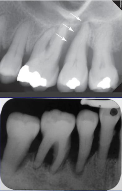 <ul><li><p>Inflammatory lesions of periodontal or pulpal origin may develop independently and merge</p></li><li><p>One may induce the other</p><ul><li><p>Periodontal lesion may extend to apex causing secondary pulpitis</p></li><li><p>Periapical inflammatory disease may extend coronally to crest causing retrograde periodontitis</p></li></ul></li><li><p>Angular defect to apex communicating with periapical rarefying osteitis</p><ul><li><p>Usually relatively uniform width</p></li><li><p>Widens slightly at crest creating funnel shape</p></li></ul></li><li><p>May affect one or multiple surfaces of tooth or be circumferential</p></li><li><p>Treatment is complicated – both endodontic and periodontal therapy</p></li></ul><p></p>