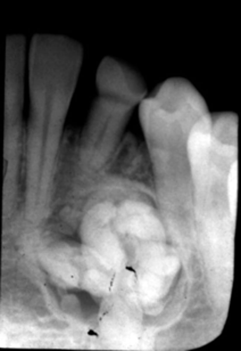 <p>Patient presents with well defined, corticated, radiolucent band that surrounds many radiopacities that are similar in density to enamel, located on the posterior mandible. The roots of adjacent teeth are displaced. What is the diagnosis?</p>