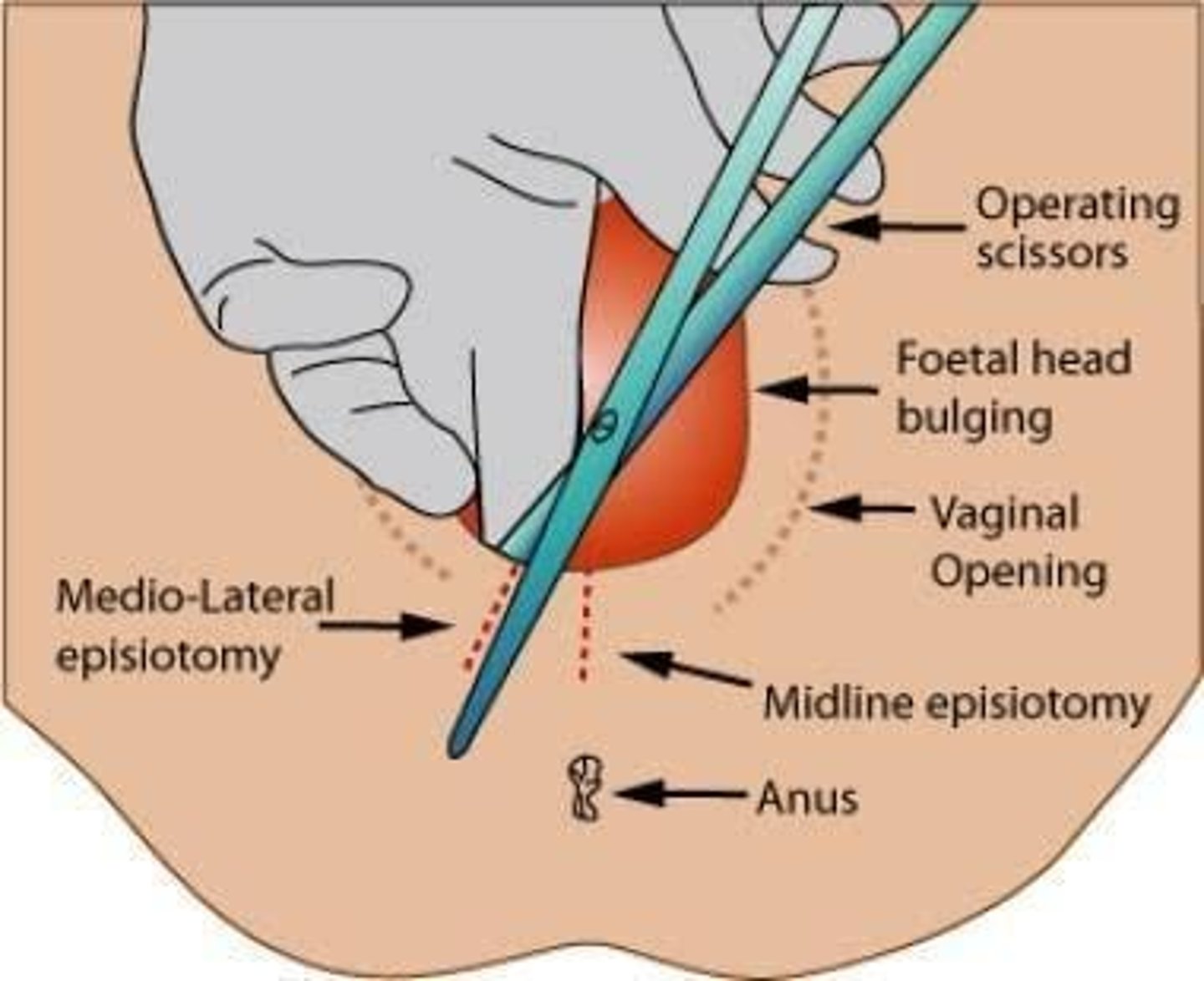 <p>The perineum is the muscular area posterior to the fourchette that stretches during childbirth to allow the passage of the fetal head.</p>