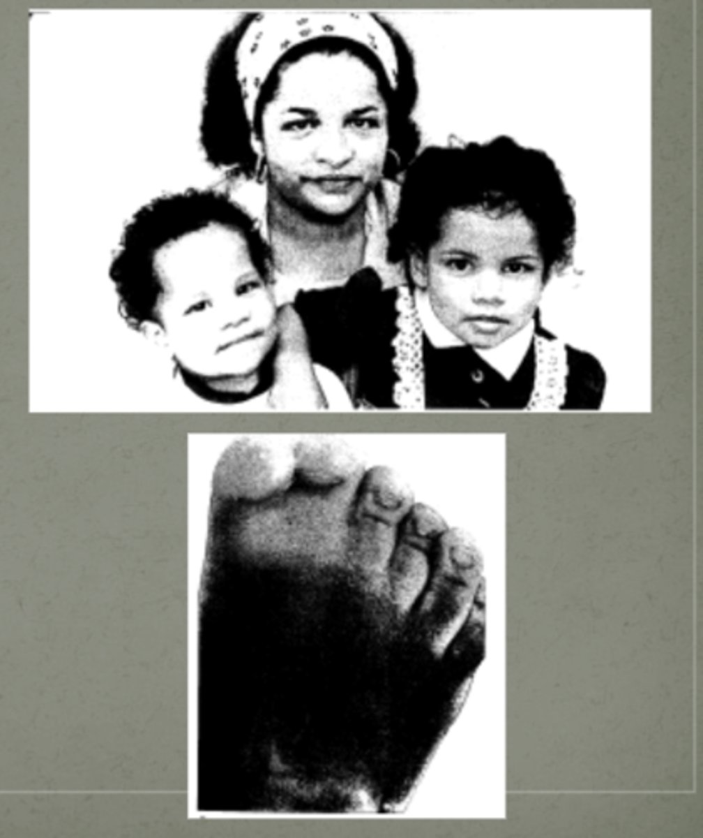 <p>Greig Cephalopolysyndactyly Syndrome</p>