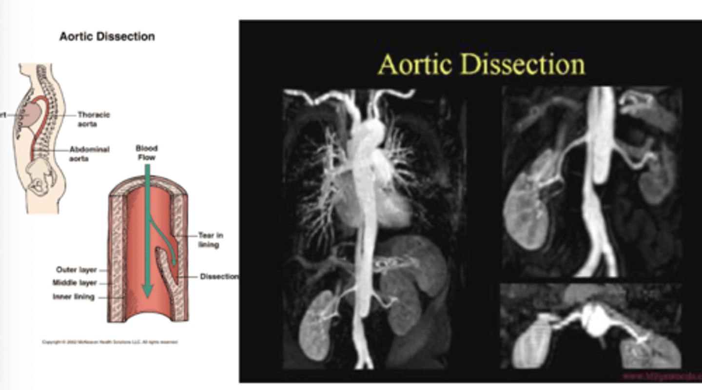 <p>CT scan with contrast is test of choice</p>
