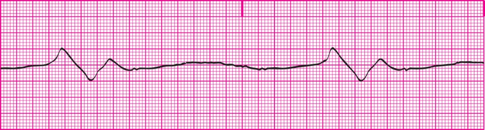 <p>Occurs when all the pacemakers of the heart have failed; the heart is dying; ventricular rate is less than 20bpm</p><p></p><p></p><p>Rhythm: There is no P-P interval; R-R may or may not be regular</p><p>Rate: Ventricular- Less than 20bpm; Atrial- cannot be determined</p><p>P wave: No P wave is present</p><p>QRS: 0.12 secs or greater; wide, bizarre appearance</p><p>Profound loss of cardiac output.</p><p>Patient will be unconscious.</p><p>Notify health care practitioner immediately.</p><p>This is a medical emergency; BLS and ACLS interventions will be initiated.</p><p>ECG strips must be saved and put in medical record.</p><p><em>**Medical Emergency</em>**</p>