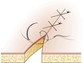 <p>Identify this suture pattern.</p>