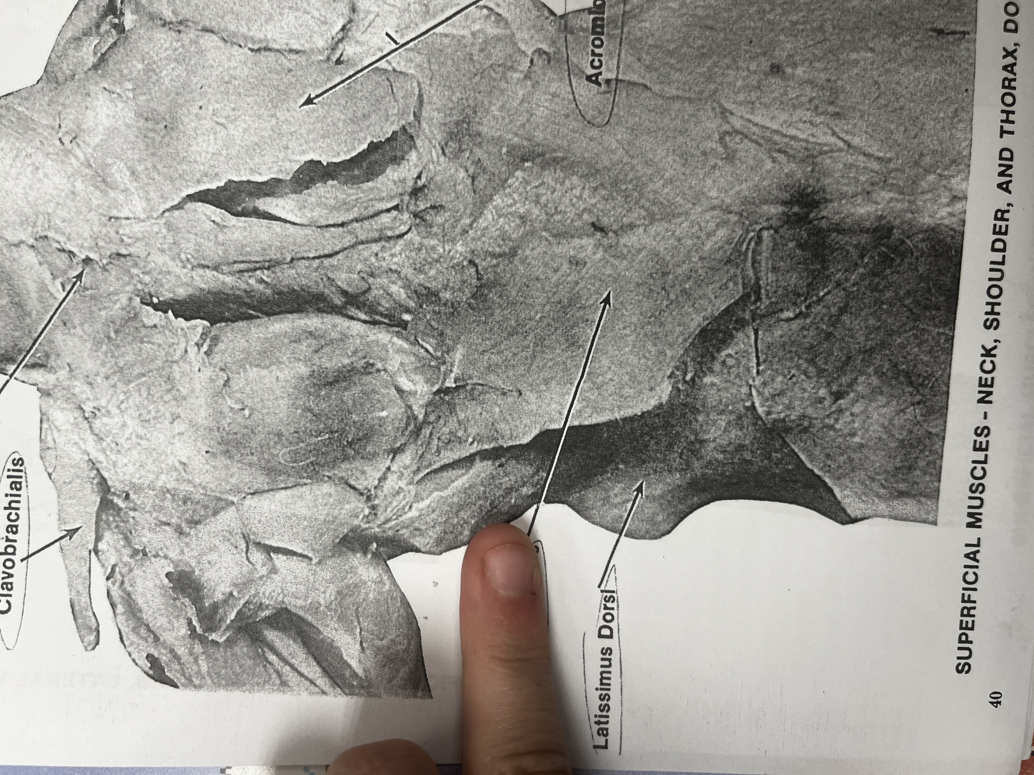 <p>A muscle in the back that retracts the scapula.</p>