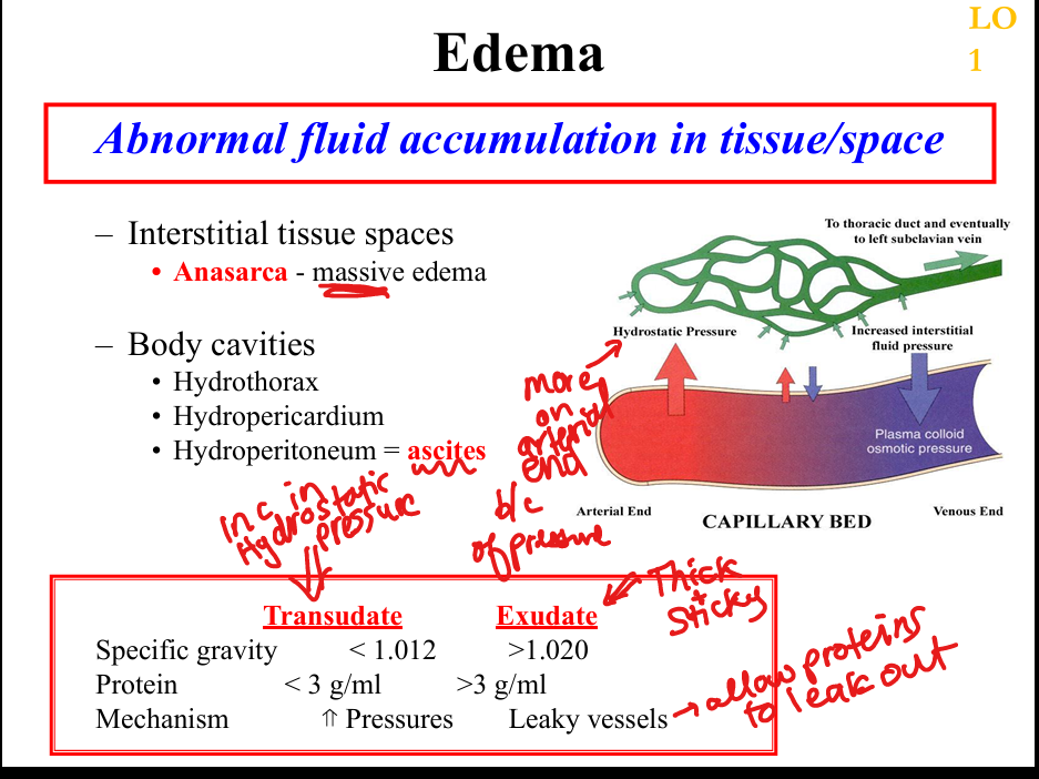<p>High protein fluid (>3 g/dL), specific gravity >1.020, due to leaky vessels </p>