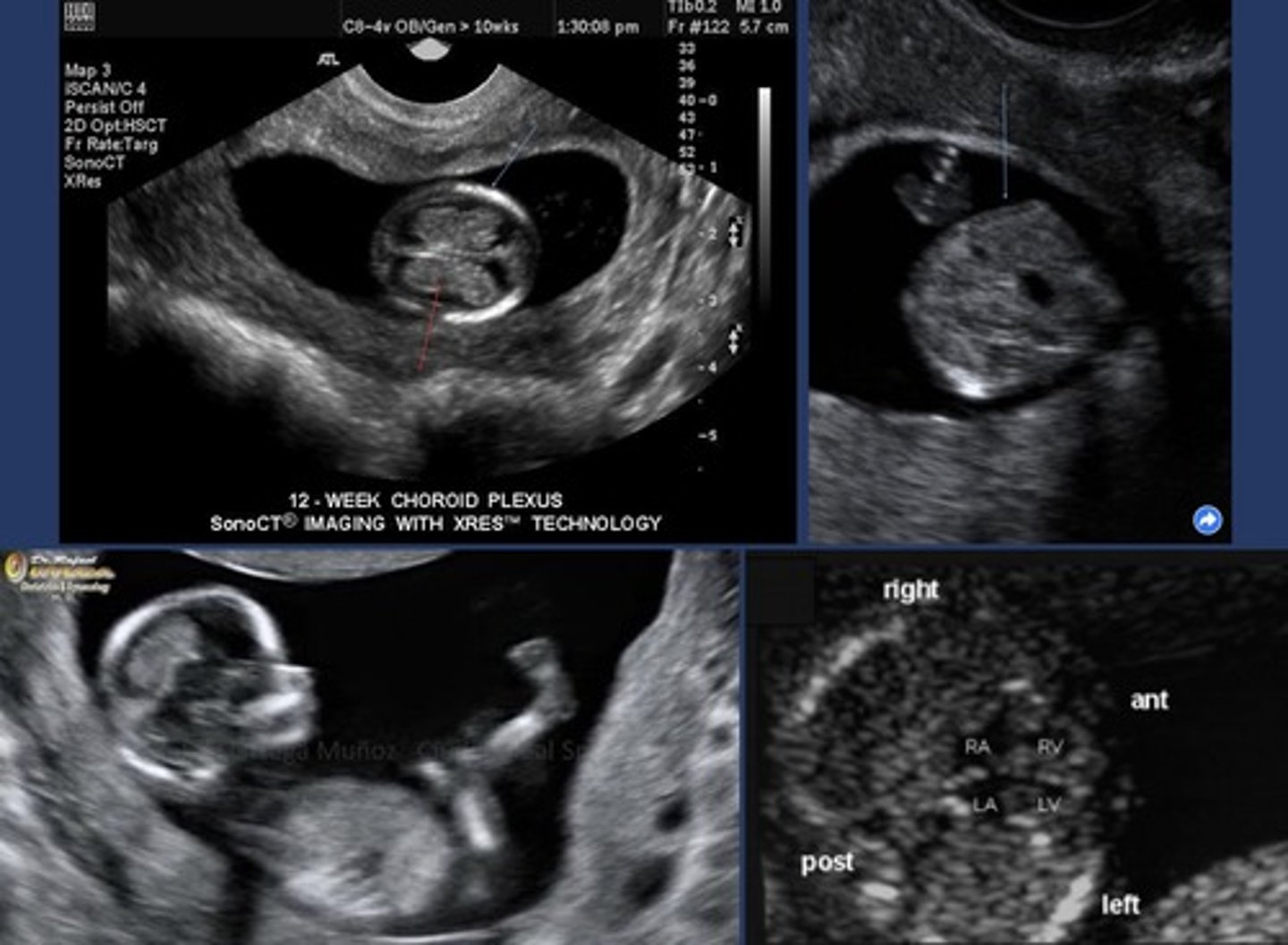 <p>Ossification of bones begins</p>