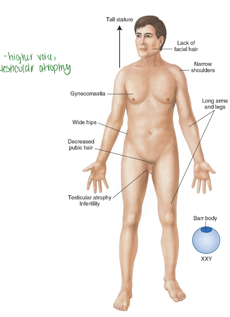 <p>47 (should have 46), XXY (get extra X).</p><p>Decreased cognitive development Testosterone replacement needed. Effects men, Don’t develop male secondary characteristics due to Extra X</p><p>Treat with testosterone treatment, may lead to infertility if not treated. Higher voice, testicular atrophy.</p>