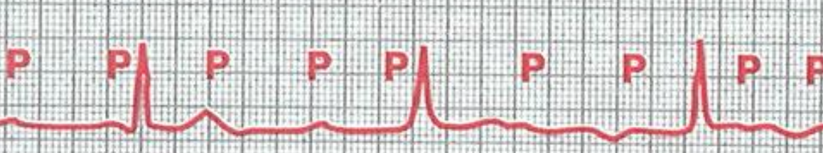 <p>A complete loss of electrical communication between the atria and the ventricles (Super abnormal ECG)</p>