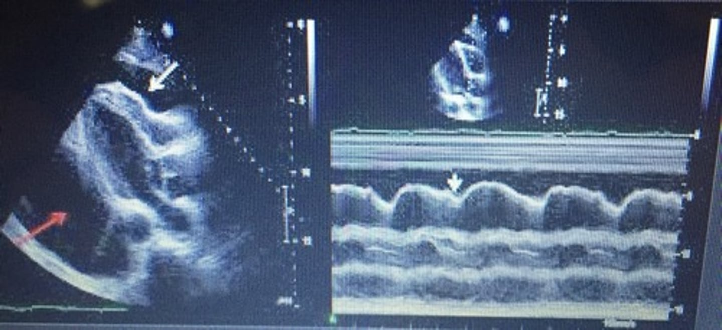 <p>build-up of fluid in the pericardium (above DA)</p>