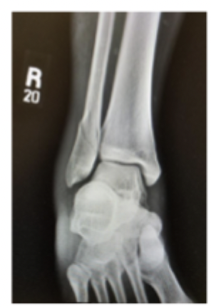 <p>gameplan for a stable Lateral Malleolus Weber B fracture</p>