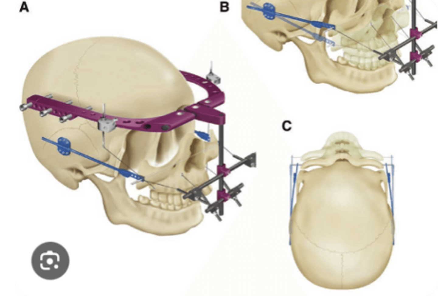 <p>1. Reducing Part</p><p>Repositions fracture fragments.</p><p>Restores normal occlusion.</p><p>Often uses a mandibular arch bar.</p><p>2. Fixation Part</p><p>Anchors the reduced maxilla to the cranium.</p><p>Consists of:</p><p>Cranial fixation elements → attached to skull.</p><p>Maxillary fixation elements → attached to maxilla.</p><p>Connecting rods and wires → connect cranial and maxillary components.</p>