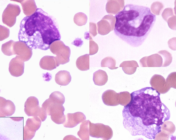 * Typically larger than neuts


* Less nuclear segmentation
* Nuclear chromatin less coarse/dense 
  * Bc still actively transcribing things
* Blue cytoplasm
* Often contain vacuoles

FXN

* Migrate into tissues to become macrophages
* Phagocytize foreign material, dead/dying cells
* Critical role in initiating, maintaining, and resolving inflammation
  * Antigen presentation
  * Cytokine production