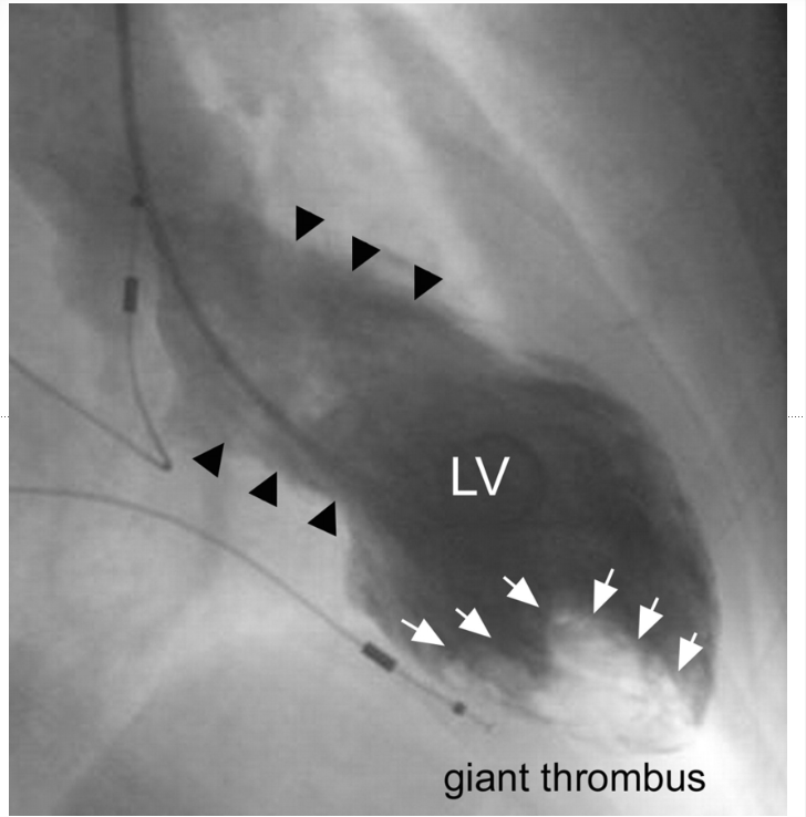 <p>thrombus</p>