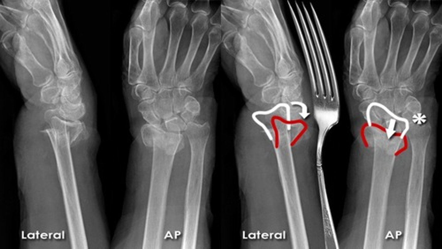 <p>lateral projection: curved morphology </p><p>AP projection: relatively straight.</p>