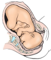 <p><strong>Cardinal Movements: Internal Rotation</strong></p><p>-Upon descent into the midpelvis, the fetal vertex undergoes ________ rotation from a transverse position so that the ________ suture is parallel to the ______________ diameter of the pelvis (OA or OP)</p>