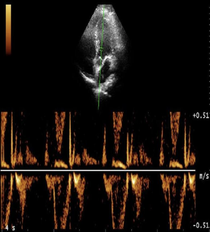 <p>How would you correct the issue with the Doppler tracing?</p>