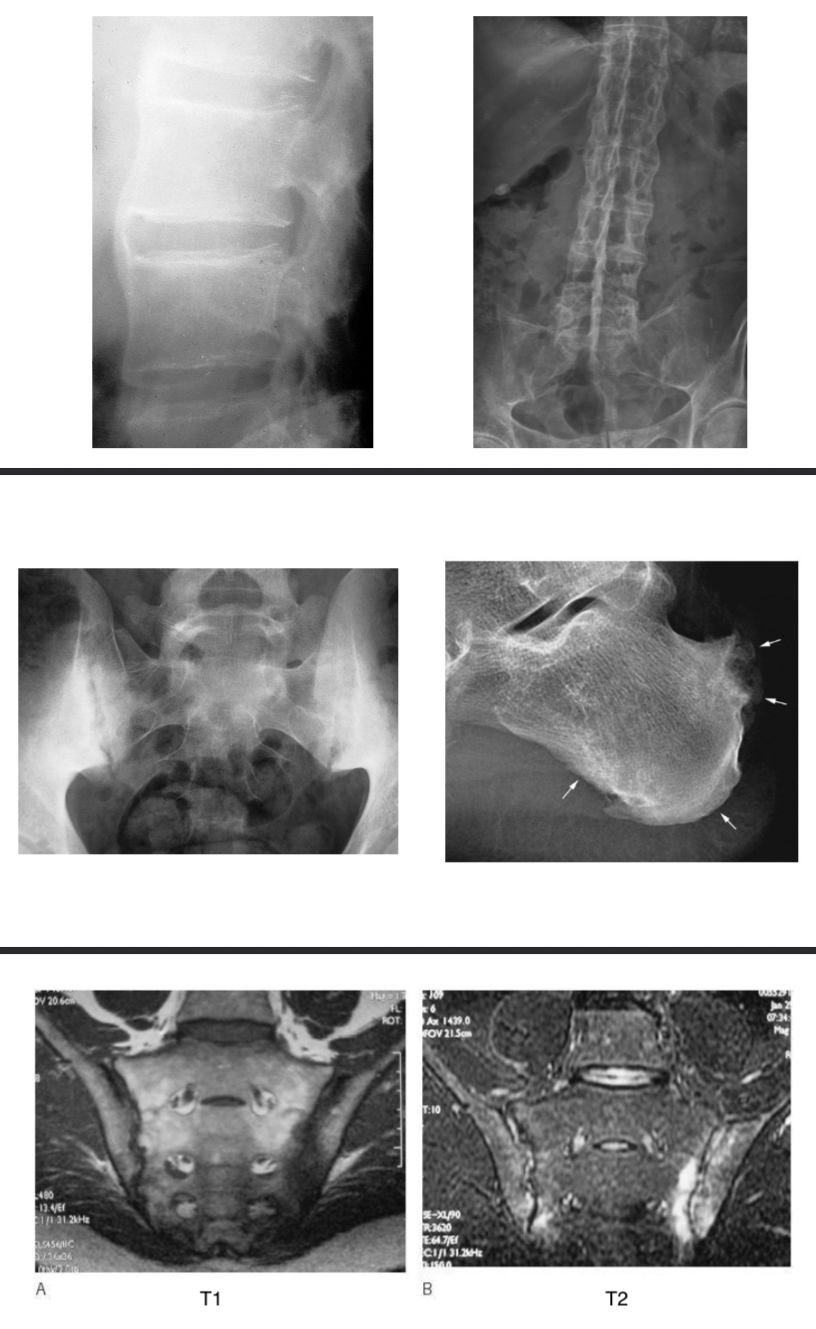 <p>SPA = ensemble de maladies inflammatoires qui partageant manifestations et terrain génétique </p><p>4 syndromes : </p><ul><li><p>syndrome pelvi-rachidien ou  axial (rachis et sacro-iliite) </p></li><li><p>Syndrome enthésopathique </p></li><li><p>Syndrome articulaire périphérique </p></li><li><p>Syndrome extra-articulaire </p></li></ul><p></p><p>Radio : </p><ul><li><p><span>﻿rachis cervical, thoracique et lombaire (face + profil) et bassin (face)</span></p></li><li><p><span>﻿syndesmophyte : ossification d'une enthèse vertébrale, spécifique d'une SpA (aspect fin et direction verticale) pouvant aller jusqu'à la « colonne bambou » </span></p></li><li><p><span>sacro-iliite : aspect « flou » des berges articulaires, condensation, érosions pouvant aller jusqu'à la fusion complète</span></p></li><li><p><span>﻿calcanéite inflammatoire</span></p></li></ul><p></p><p>IRM rachis thoraco-lombaire +caro-iliaques = remaniements inflammatoires précédant les modifications radio </p><p></p>