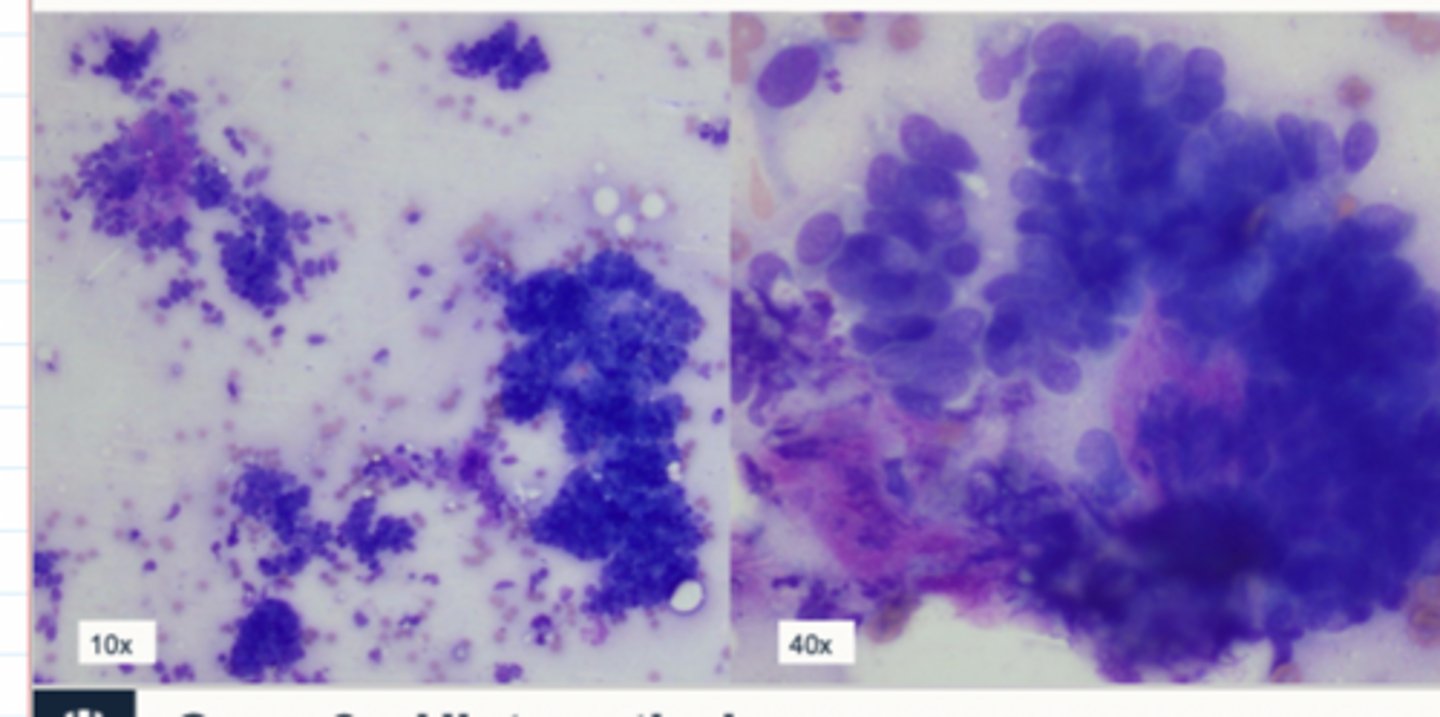 <p>Case 3 Cytology</p><p>1. what is the cell harvest</p><p>2. how are the cells distributed</p><p>3. what shape are these cells</p><p>4. what cell type are they</p>
