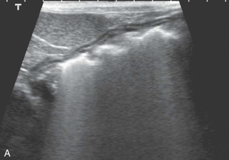 <p>Reverberation (Ring Down)</p>