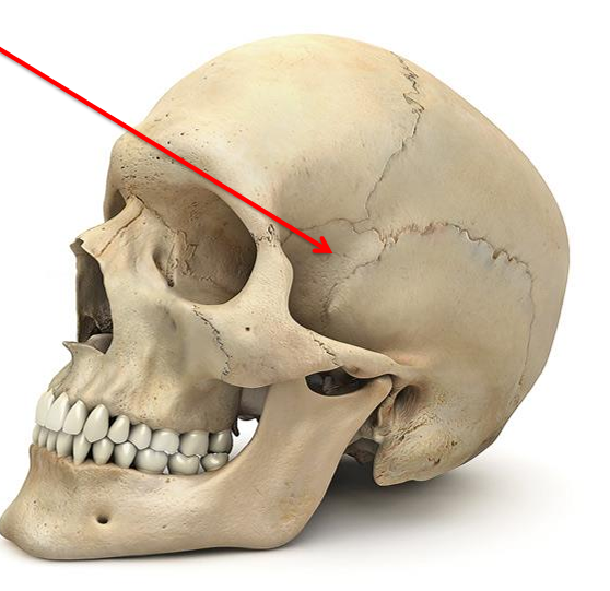 <p>frontal bone, sphenoid bone, fronto-temporal bone, or suborbital bone</p>