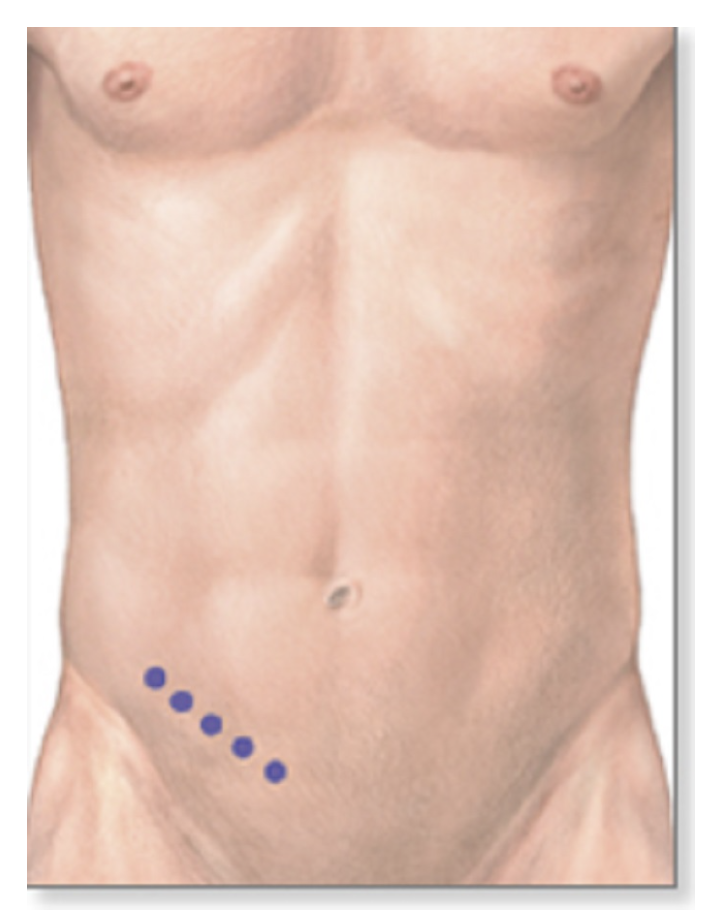 <p><span>A 23-year-old male undergoes routine evaluation 1-week after an emergency appendectomy. Physical examination reveals a "classic" and healing surgical incision site in the right inguinal region. Upon palpation of the anterior abdominal wall, suprapubic sensory loss is noted just superior to the pubic bone.&nbsp;An injury to which of the following nerves best explains this patient's presentation? (Image attached)</span></p>