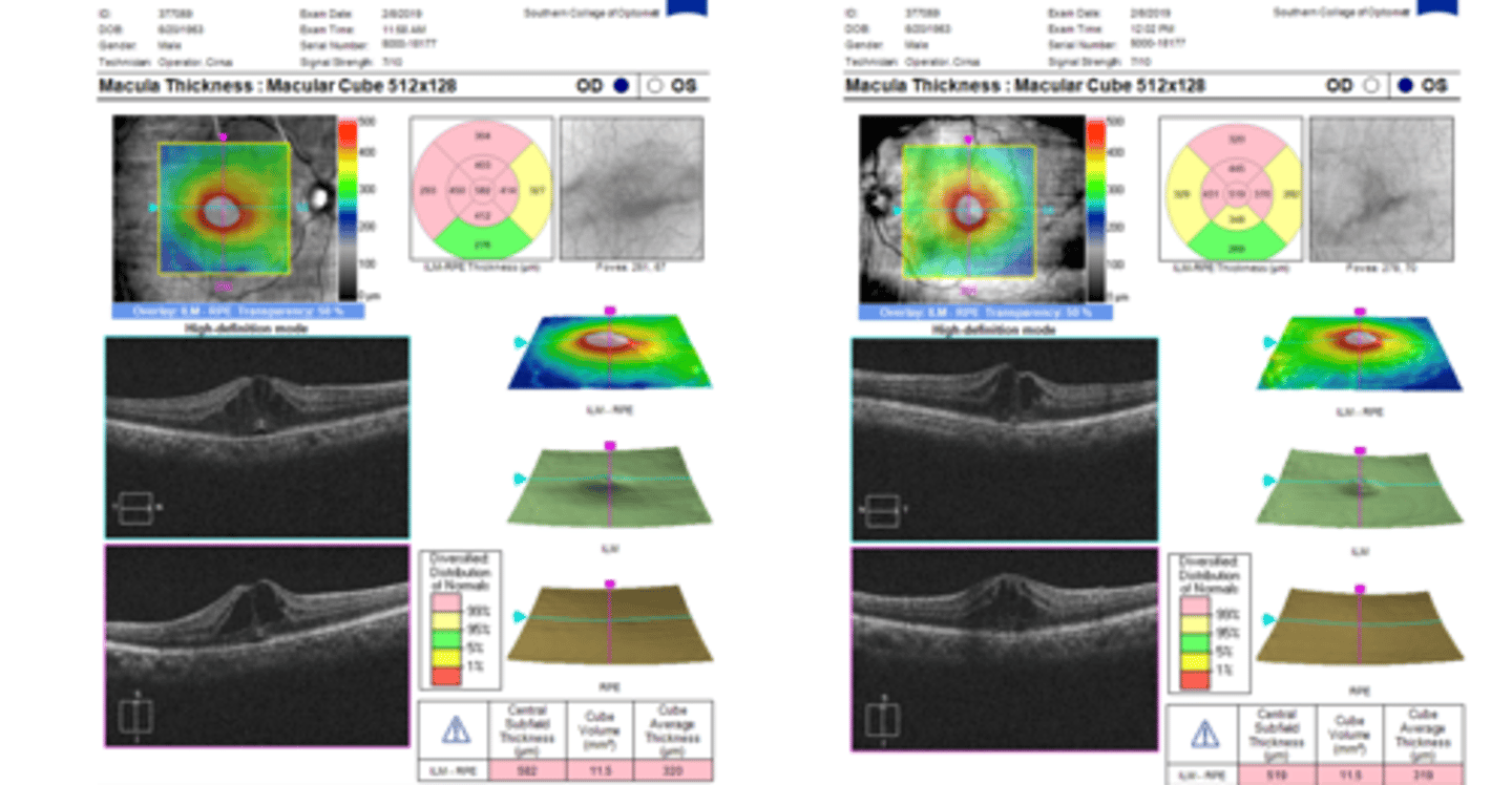 <p>optically empty hyporeflective cysts, mostly in OPL and INL</p>