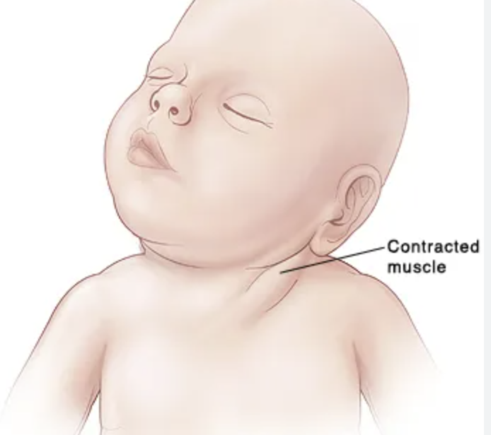 <p>Painfully twisted and tilted neck can be congenital or acquired (resolves in several days or a couple of weeks)</p>