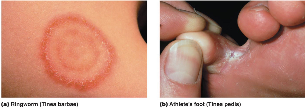 * occur on the head, groin, feet, or nails 
* Fungus metabolizes keratin in epidermis 
* Usually treated with topical antifungal drugs or griseofulvin (oral)

  \
