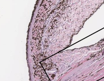 <p>Which type of primary glaucoma is due to an abnormal iridocorneal angle and is seen in cocker spaniels, basset hounds, and Chow-chows?</p>
