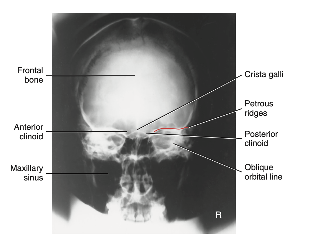 <p>What is <u>best demonstrated</u> for <strong>PA projection (</strong><span style="color: green"><strong>axial + w/o angle</strong></span><strong>) </strong>method for <strong>skull</strong>?</p>