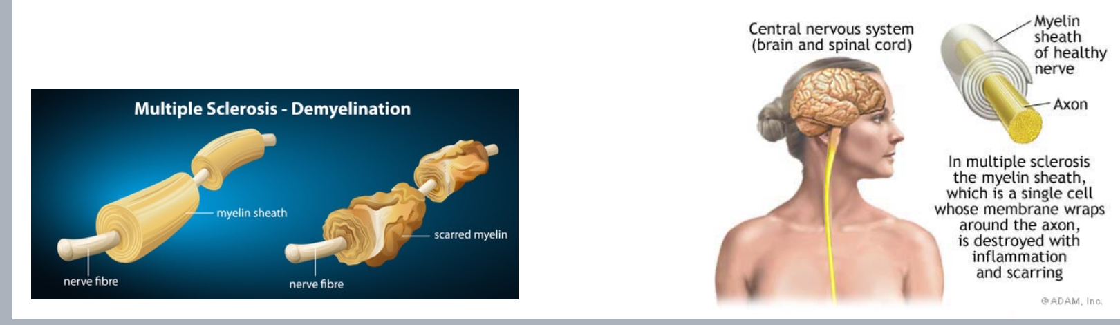 <p>Demyelination- autoimmune -  inflammatory destruction of CNS myelin</p><p>Scarred myelin Because the nervous system goes little by little it takes long</p>