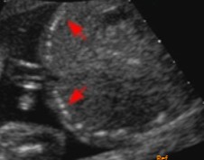 <p>Bowel obstruction has occurred in the fetus, and this was seen on the scan. </p><ol><li><p>What US finding is seen here?</p></li><li><p>What pathology is it an indication for?</p></li></ol><p></p>