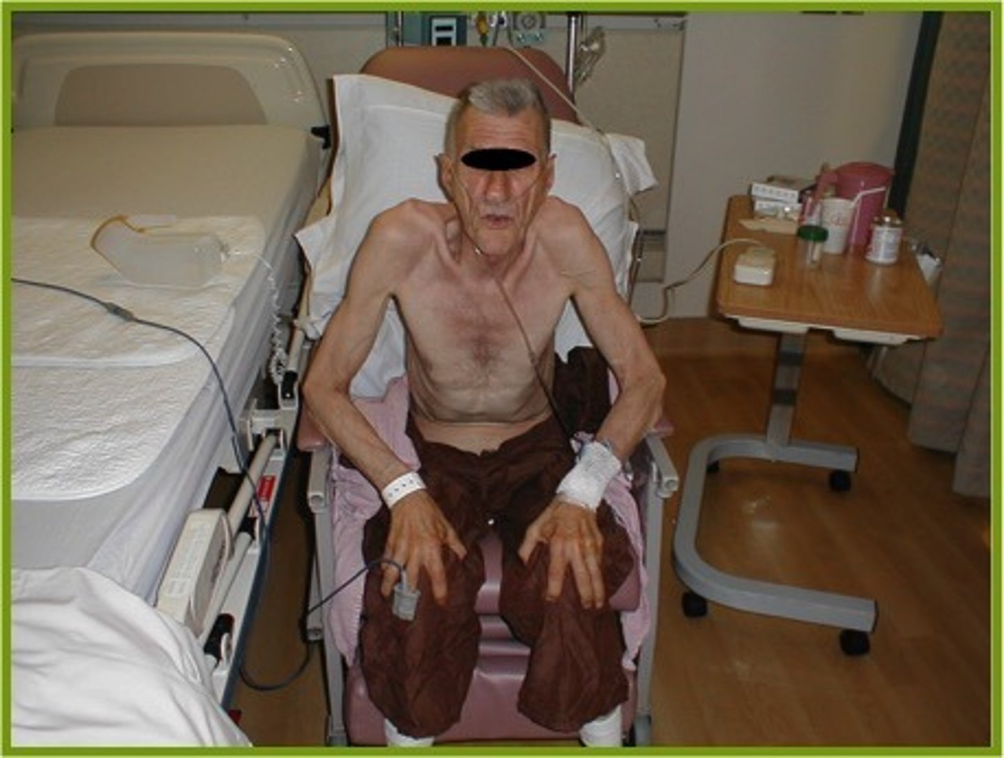 <p>an upright position in which the patient leans forward onto two arms stretched forward and thrusts the head and chin forward; typically seen in patients having difficulty breathing</p>