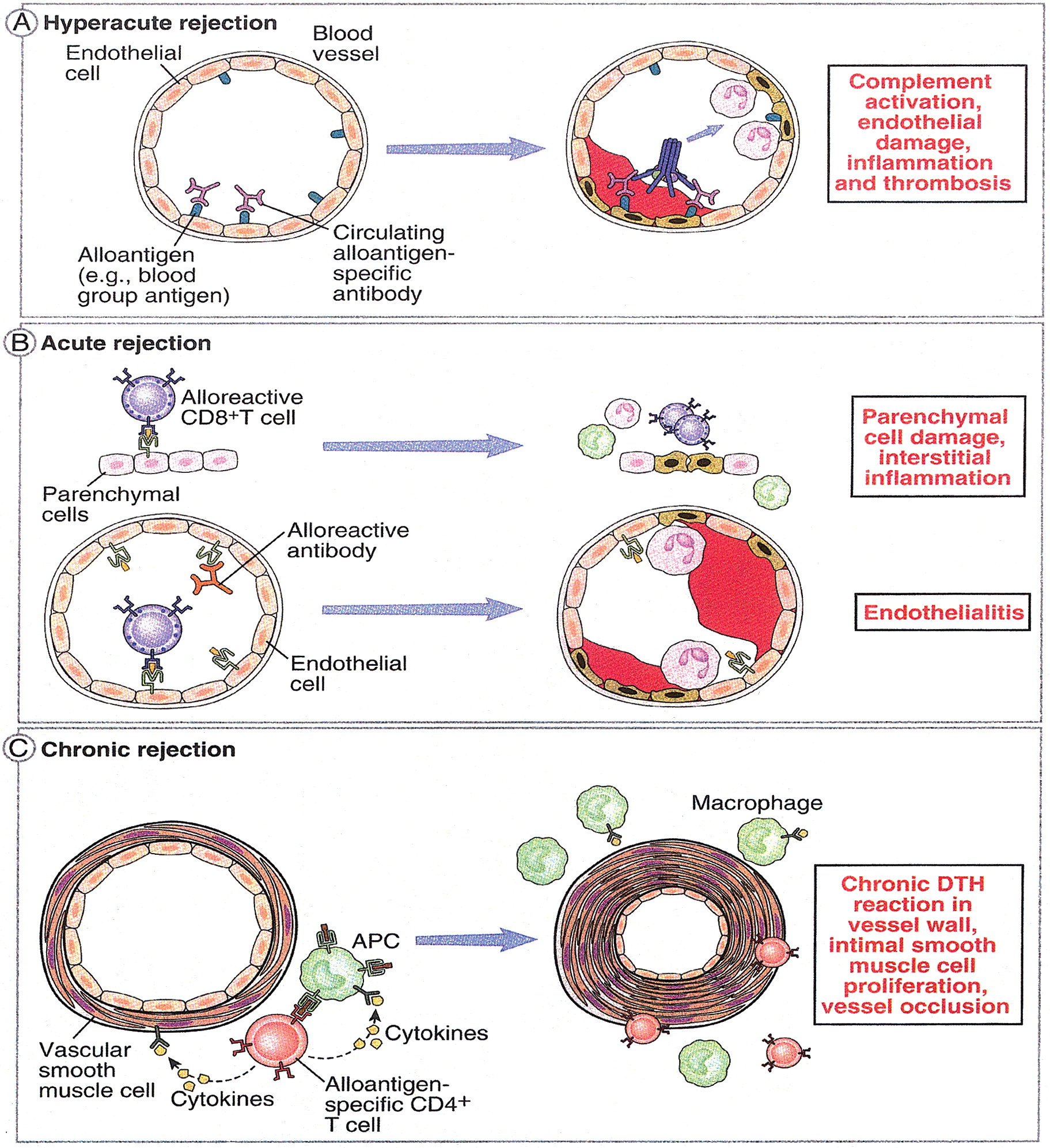 <ol><li><p>Hyperacute rejection (within hours)</p></li><li><p>Acute rejection (first few weeks)</p></li><li><p>Chronic rejection (years)</p></li></ol><p></p>