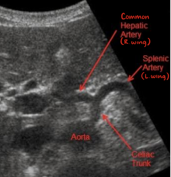 <p>consists celiac trunk, common hepatic artery (right wing), and splenic artery (left wing)</p>