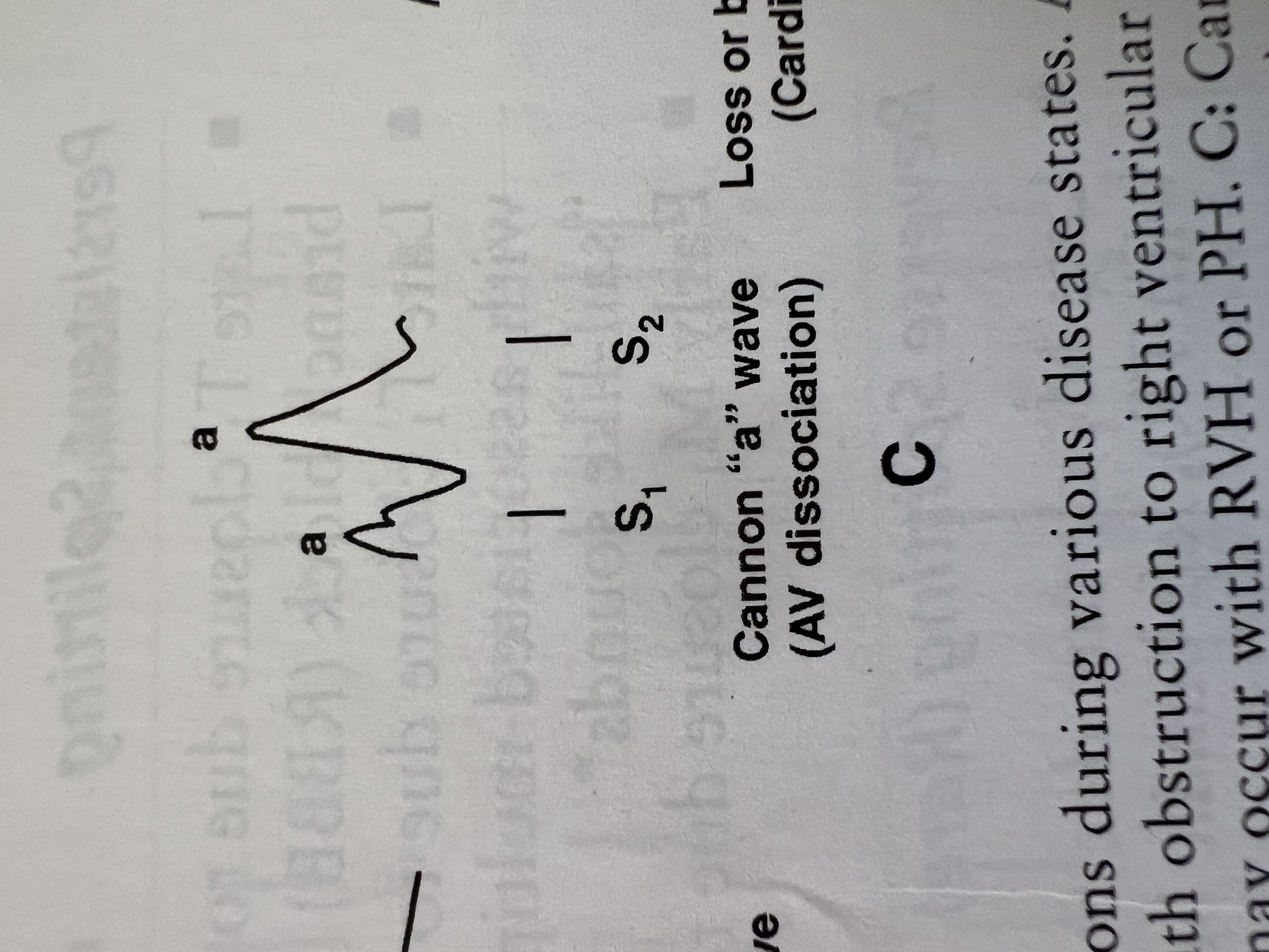 <p>What causes cannon 'a' waves, characterized by intermittent prominent 'a' waves during ventricular systole?</p>