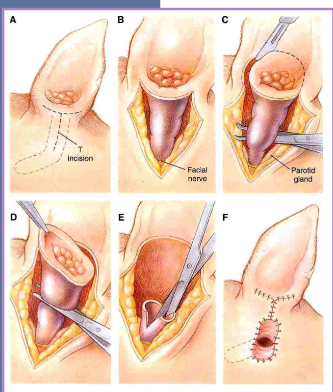 <ul><li><p>indicated for vertical canal disease </p><ul><li><p>tumor infiltrating vertical canal </p></li><li><p>otitis externa confined to the vertical ear canal </p></li></ul></li><li><p>horizontal canal must be normal </p></li><li><p>better cosmetic appearance than with lateral resection when abundant hyperplastic tissue is present in and around vertical ear canal </p></li></ul><p></p>