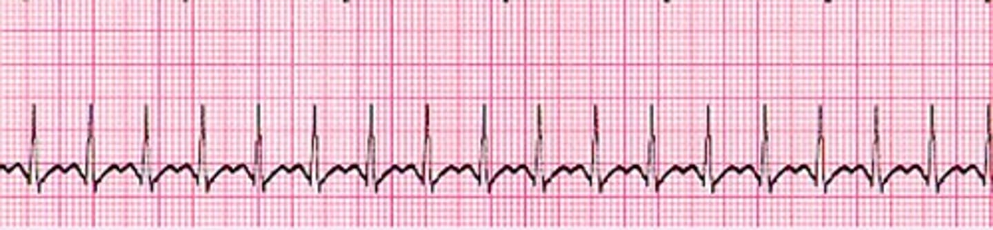 <p>What does the ECG show?</p>