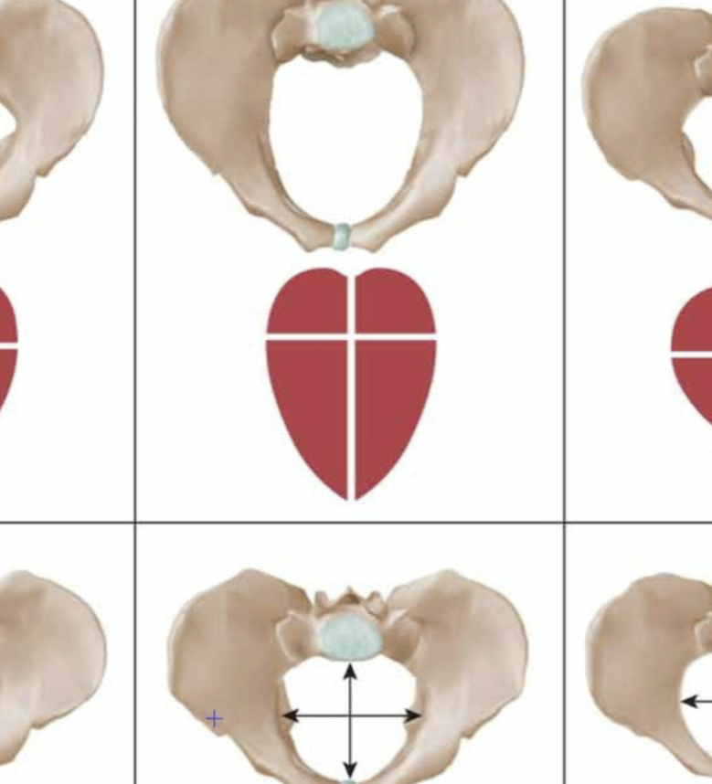 <p>ape like pelvis w/ incidence of 25%; <strong>long antero-posterior oval shape</strong>; OP presentation is common (sunny-side up)</p><ul><li><p><strong>favorable for vaginal birth</strong></p></li></ul><p></p>