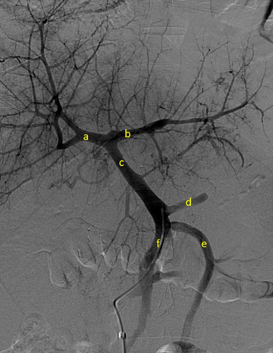 <p>A: Right portal vein</p><p>B: Left portal vein</p><p>C: Portal Vein</p><p>D: Splenic Vein</p><p>E: Inferior mesenteric vein</p><p>F: Superior mesenteric vein</p>