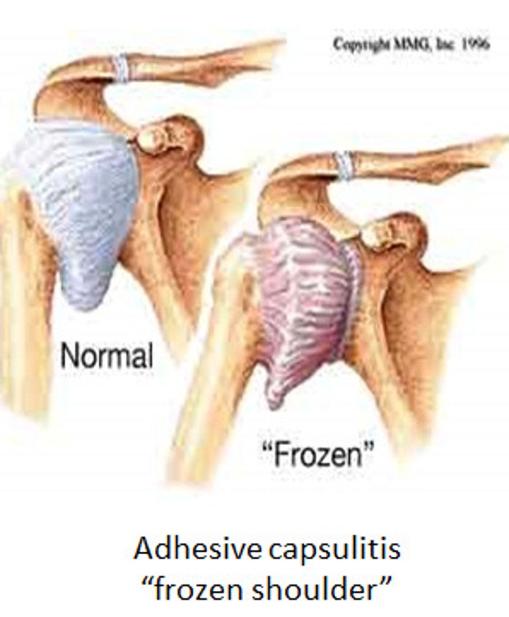 <p>Adhesive Capsulitis is another name for which pathology?</p>