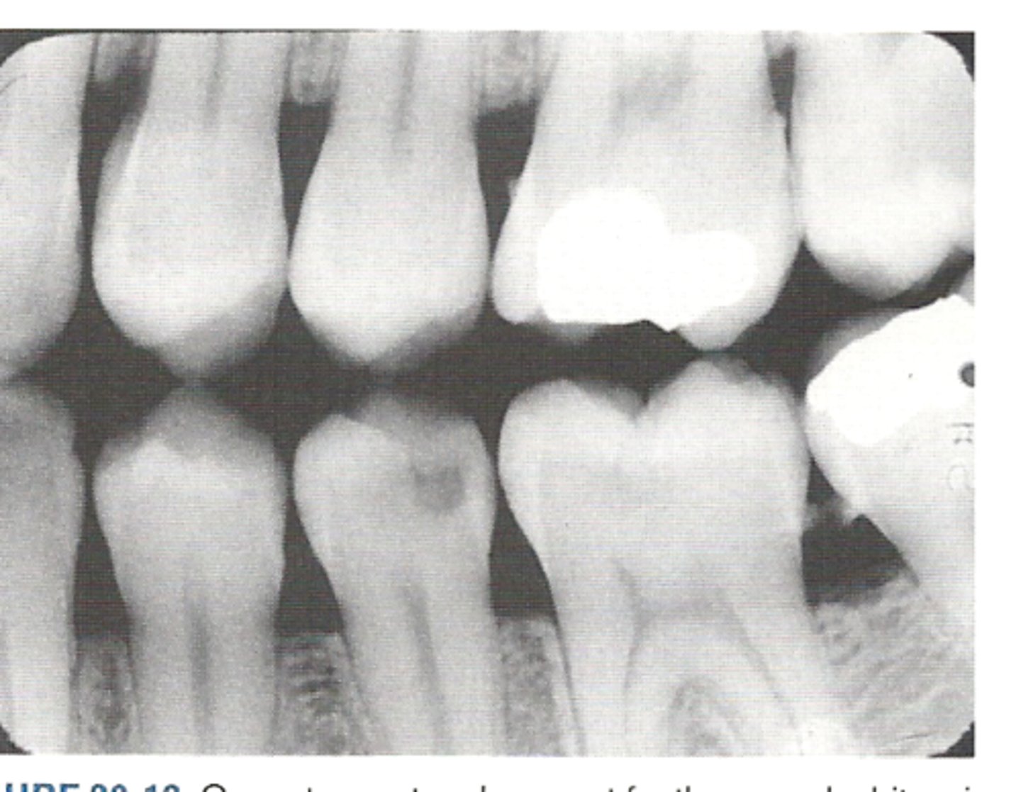 <p>or monitor interproximal caries if the proximal surfaces of the teeth cannot be visually tactilely examined</p>