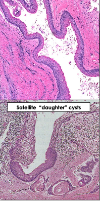 <p>What are key histological features of odontogenic keratocyst?</p>