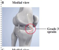 <p>- complete loss of medial stability, minimum swelling, immediate pain, loss of motion, positive valgus stress test<br><br>- tx: POLICE, limited immobilization (brace), progressive weight bearing, increased ROM</p>