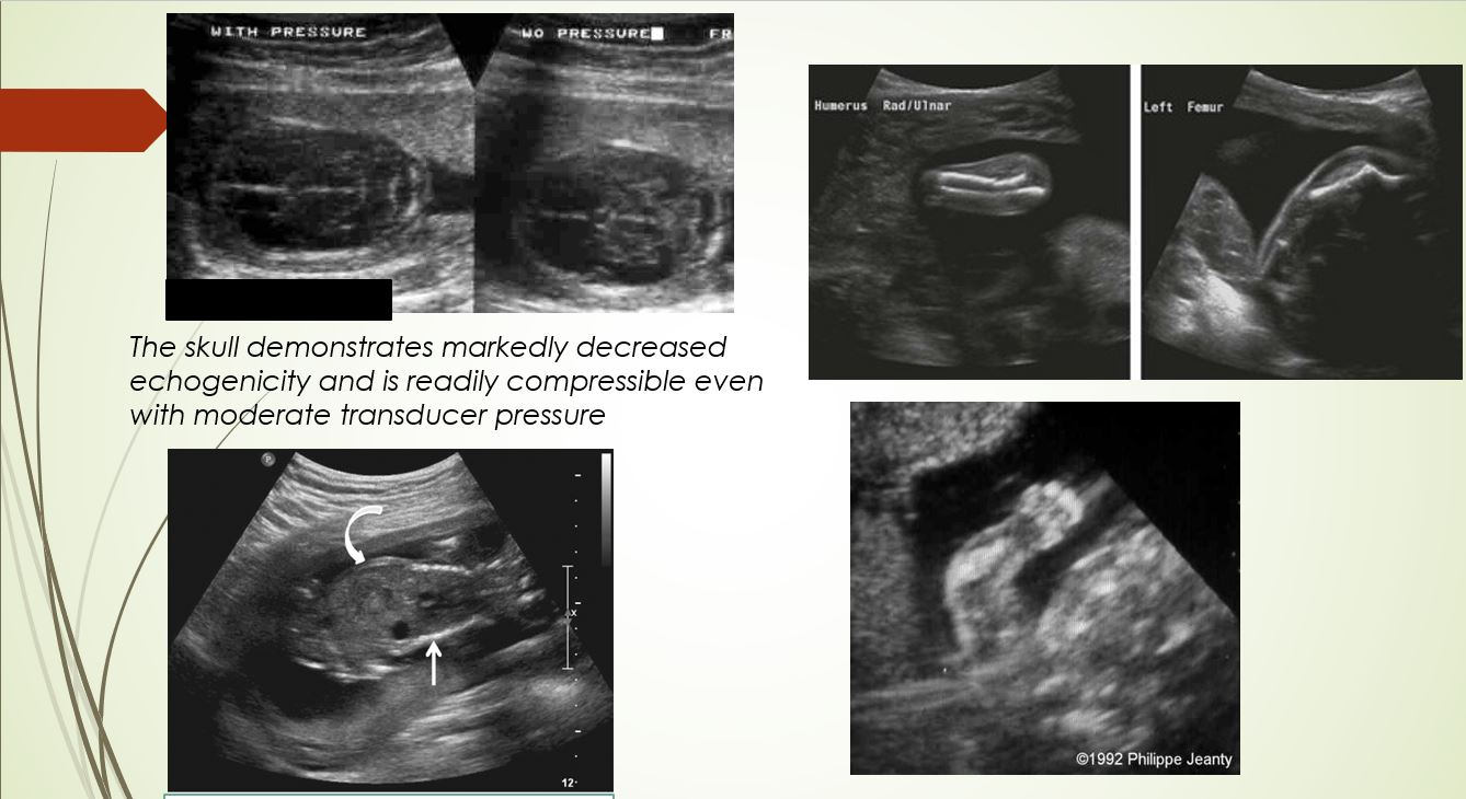 <p>Patient presents with structural anomalies with the skull decreased in echogenicity and easily compressible showing signs of decreased mineralization.</p>