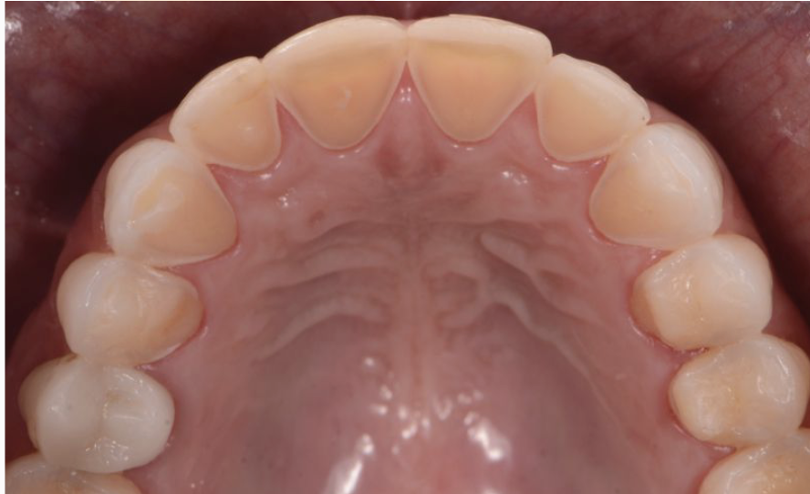 <p><span style="color: #000000">signs in mouth of GERD</span><span style="color: #000000"><br></span><span style="color: #000000">noted as acid erosion on enamel (mostly linguals and occ</span><span style="color: #000000"><br></span><span style="color: #000000">pitting), pt stating taste alterations, and pt stating bad taste in</span><span style="color: #000000"><br></span><span style="color: #000000">mouth.</span></p>