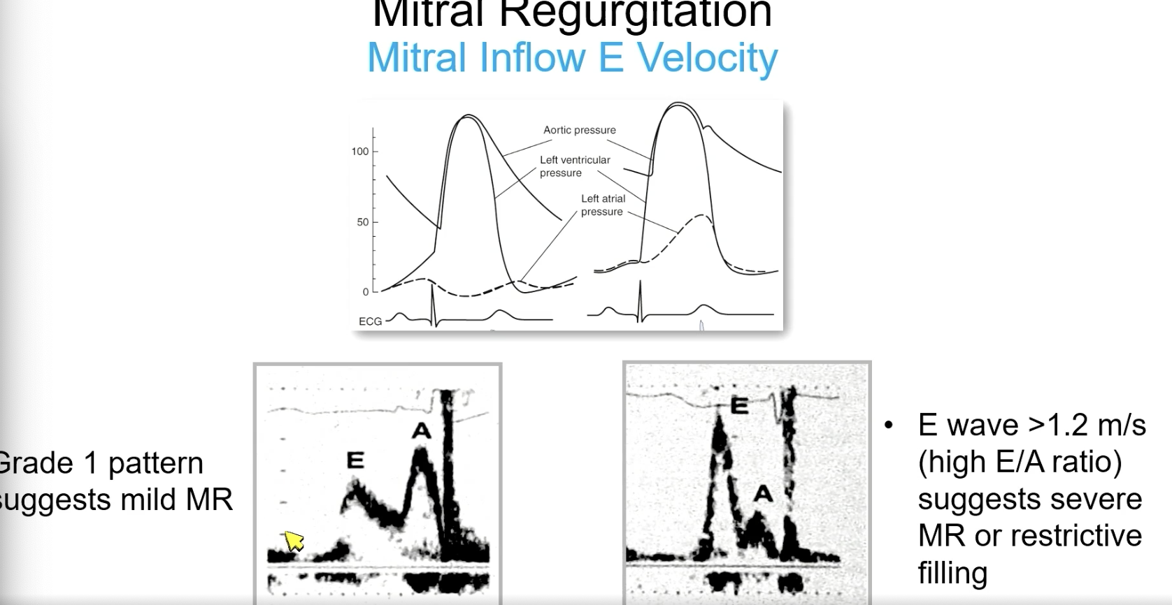 <p>severe MR or restrictive filling</p>