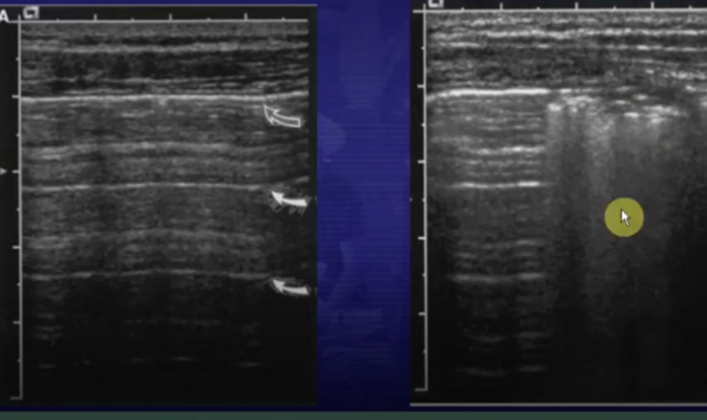 <p>reverberation ; shadowing</p>