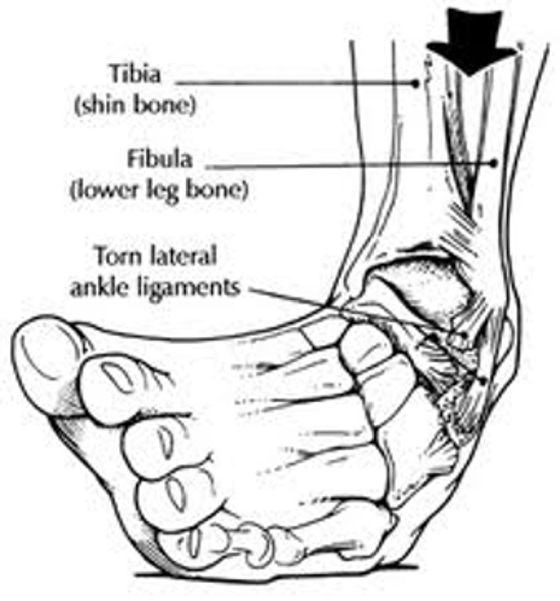 <p>Anterior talofibular ligament</p>